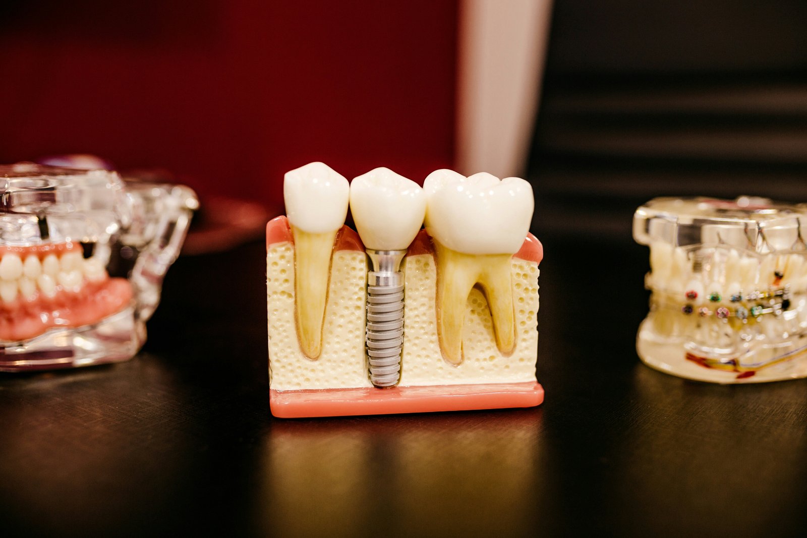 Model de implant dentar